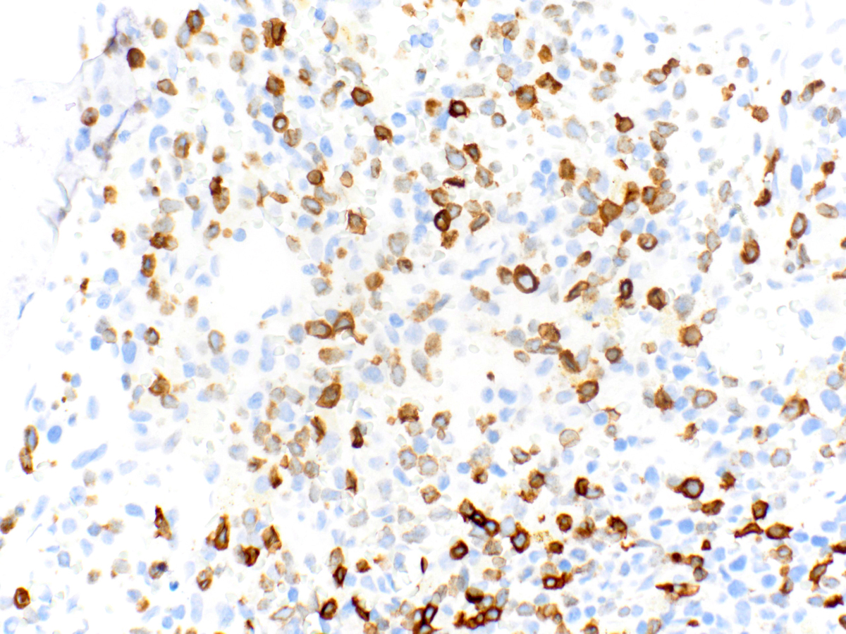 CD3 staining of subset of blasts. Weak staining of some of the larger cells is consistent with cytoplasmic staining (40x).